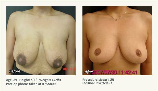Breast Lift in Plano & Dallas, TX - Patient 36