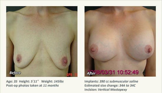 Breast Lift in Plano & Dallas, TX - Patient 40