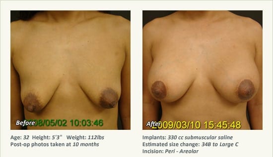 Breast Lift in Plano & Dallas, TX - Patient 42