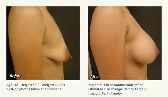 Breast Lift in Plano & Dallas, TX - Patient 43