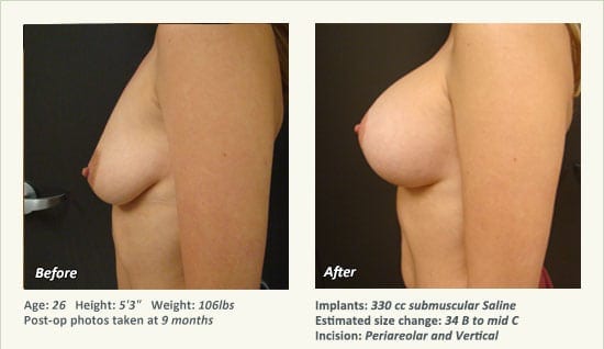 Breast Lift in Plano & Dallas, TX - Patient 47