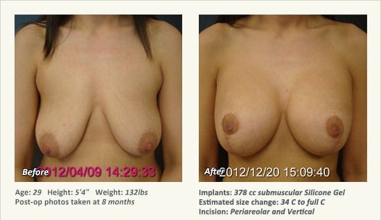 Breast Lift in Plano & Dallas, TX - Patient 48