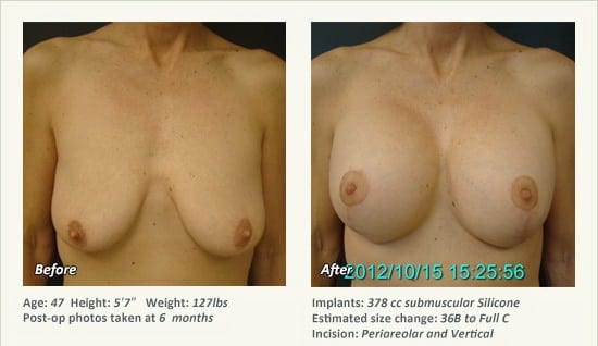 Breast Lift in Plano & Dallas, TX - Patient 50