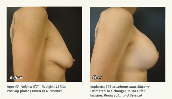 Breast Lift in Plano & Dallas, TX - Patient 51