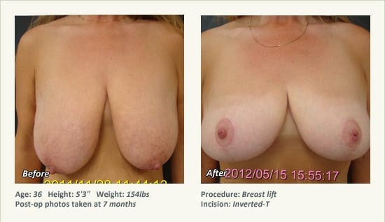 Breast Lift in Plano & Dallas, TX - Patient 52