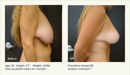 Breast Lift in Plano & Dallas, TX - Patient 53