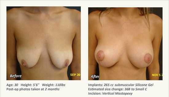 Breast Lift in Plano & Dallas, TX - Patient 54