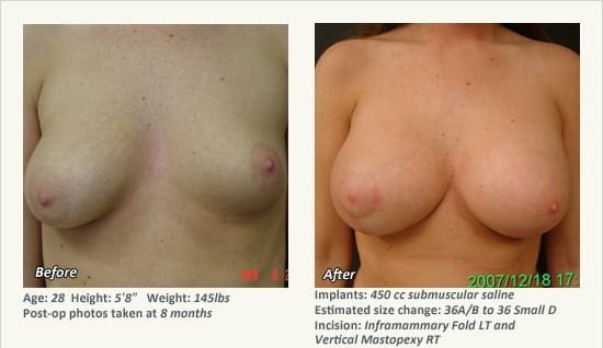 Breast Lift in Plano & Dallas, TX - Patient 58