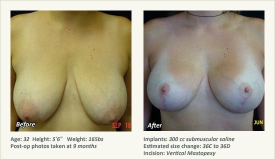 Breast Lift in Plano & Dallas, TX - Patient 60
