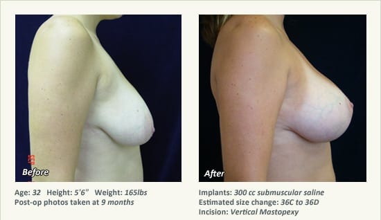 Breast Lift in Plano & Dallas, TX - Patient 61