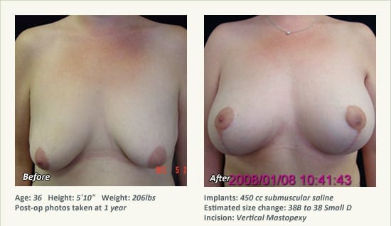 Breast Lift in Plano & Dallas, TX - Patient 62