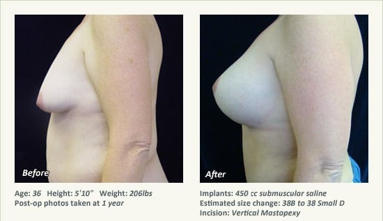 Breast Lift in Plano & Dallas, TX - Patient 63