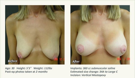 Breast Lift in Plano & Dallas, TX - Patient 64