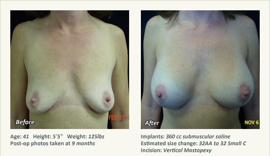 Breast Lift in Plano & Dallas, TX - Patient 66
