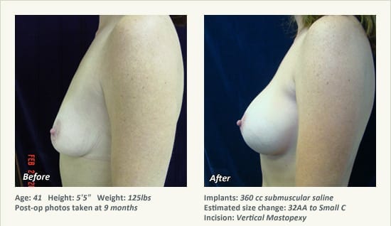 Breast Lift in Plano & Dallas, TX - Patient 67