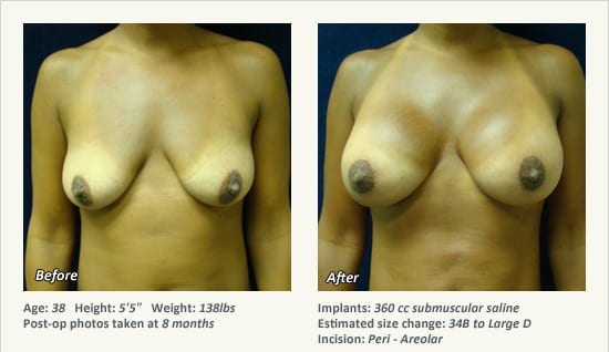 Breast Lift in Plano & Dallas, TX - Patient 68