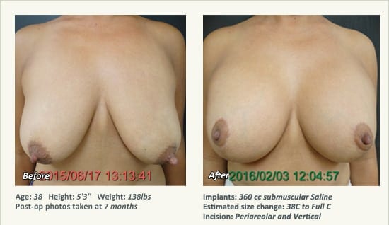 Breast Lift in Plano & Dallas, TX - Patient 72