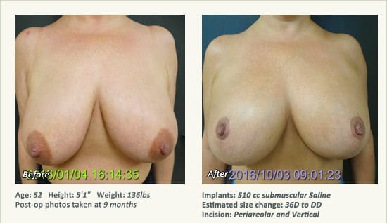 Breast Lift in Plano & Dallas, TX - Patient 74