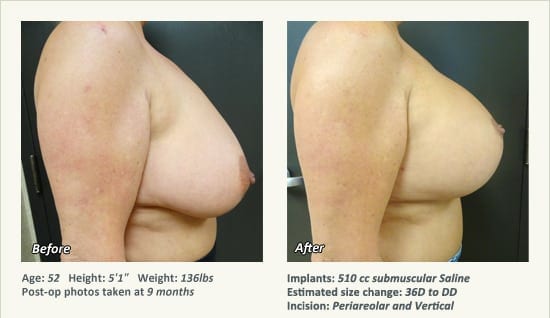 Breast Lift in Plano & Dallas, TX - Patient 75
