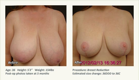 Breast Reduction (Female) in Plano, TX - Patient 41