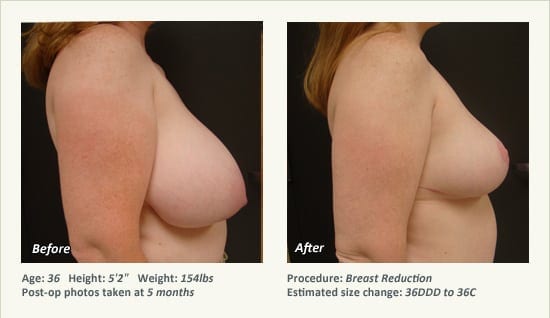 Breast Reduction (Female) in Plano, TX - Patient 42