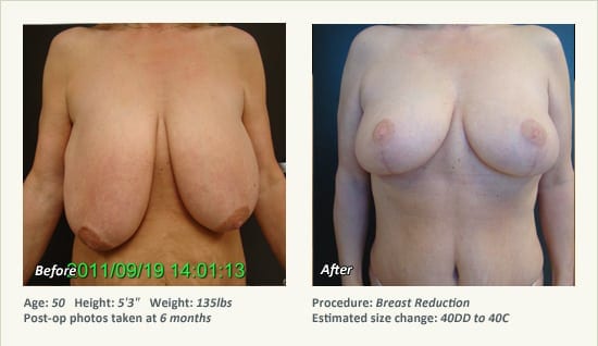 Breast Reduction (Female) in Plano, TX - Patient 43
