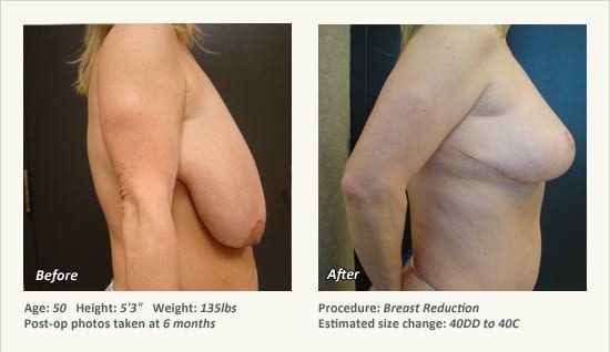 Breast Reduction (Female) in Plano, TX - Patient 44