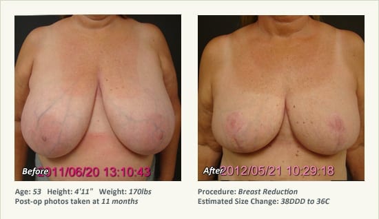 Breast Reduction (Female) in Plano, TX - Patient 45