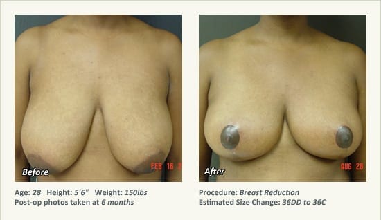 Breast Reduction (Female) in Plano, TX - Patient 47
