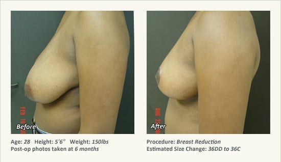 Breast Reduction (Female) in Plano, TX - Patient 48