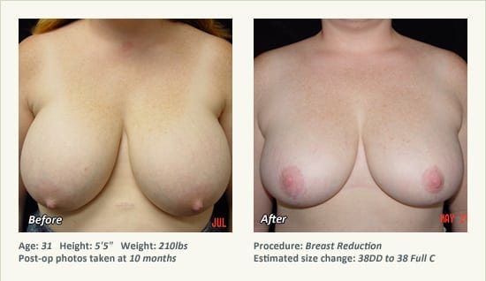 Breast Reduction (Female) in Plano, TX - Patient 49