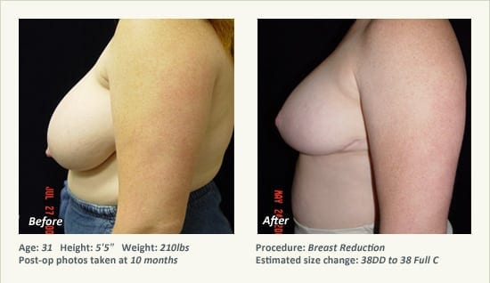 Breast Reduction (Female) in Plano, TX - Patient 50