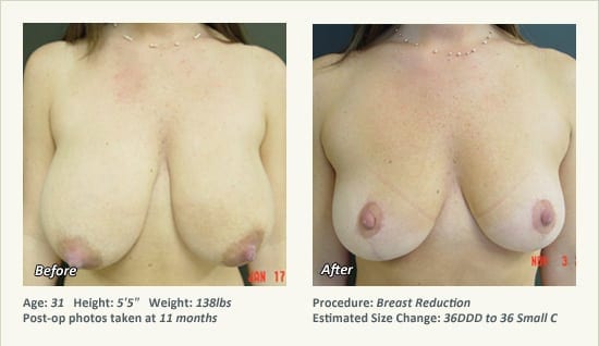 Breast Reduction (Female) in Plano, TX - Patient 51