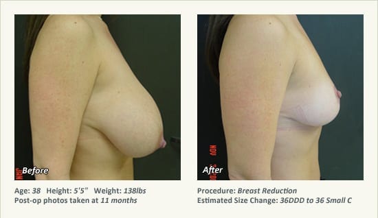 Breast Reduction (Female) in Plano, TX - Patient 52