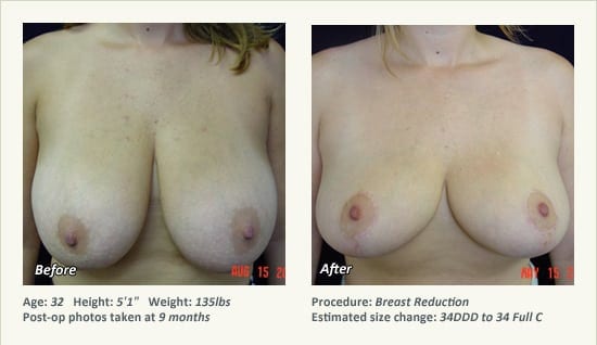 Breast Reduction (Female) in Plano, TX - Patient 53