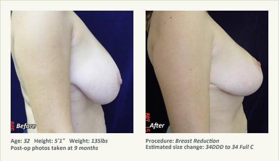 Breast Reduction (Female) in Plano, TX - Patient 54
