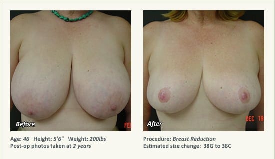 Breast Reduction (Female) in Plano, TX - Patient 55