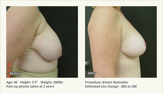 Breast Reduction (Female) in Plano, TX - Patient 56