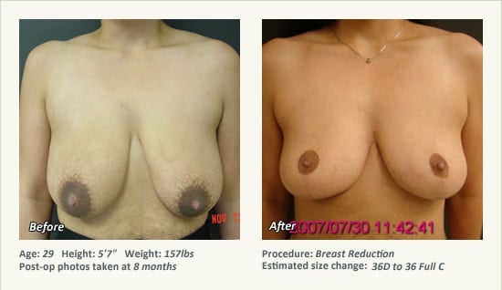 Breast Reduction (Female) in Plano, TX - Patient 57