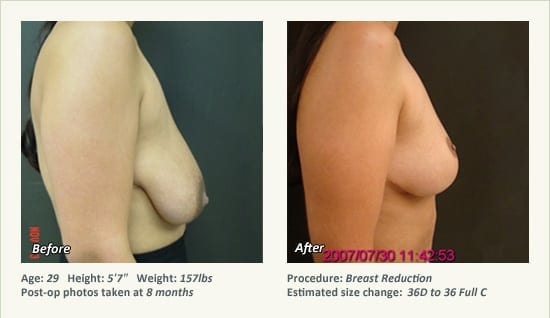 Breast Reduction (Female) in Plano, TX - Patient 58