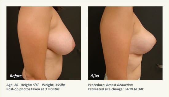 Breast Reduction (Female) in Plano, TX - Patient 60