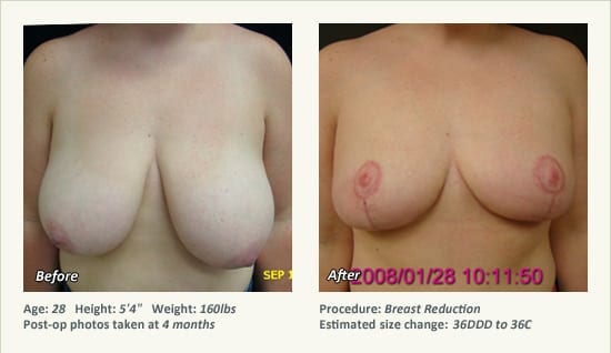 Breast Reduction (Female) in Plano, TX - Patient 61