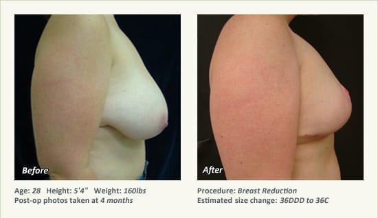 Breast Reduction (Female) in Plano, TX - Patient 62