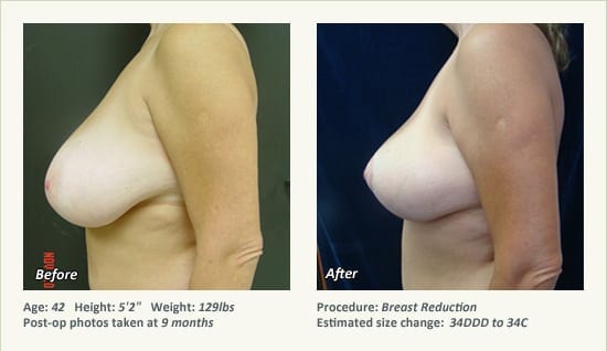 Breast Reduction (Female) in Plano, TX - Patient 64