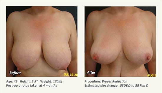 Breast Reduction (Female) in Plano, TX - Patient 65