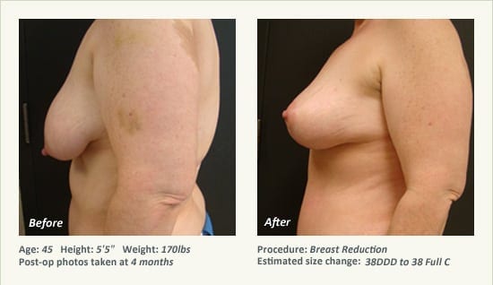 Breast Reduction (Female) in Plano, TX - Patient 66