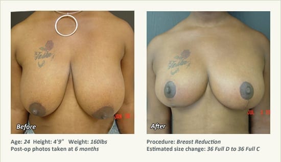 Breast Reduction (Female) in Plano, TX - Patient 67