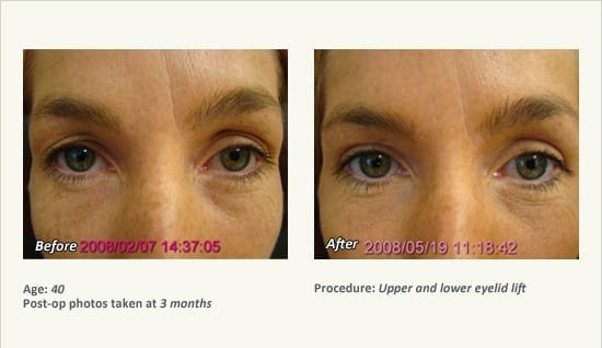 Eyelid Lift Surgery in Plano, TX - Patient 5
