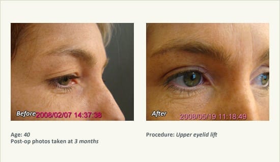 Eyelid Lift Surgery in Plano, TX - Patient 6
