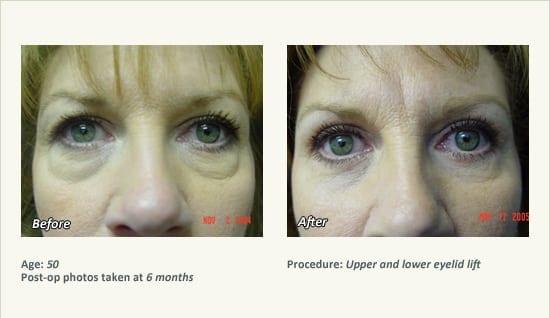 Eyelid Lift Surgery in Plano, TX - Patient 7